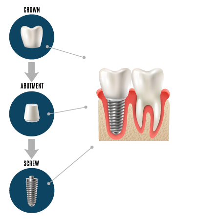 Dental Implants in Murrells Inlet